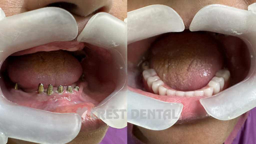 Dental implants surgery at Crest Dental Sector 63 Gurgaon - permanent tooth replacement solution