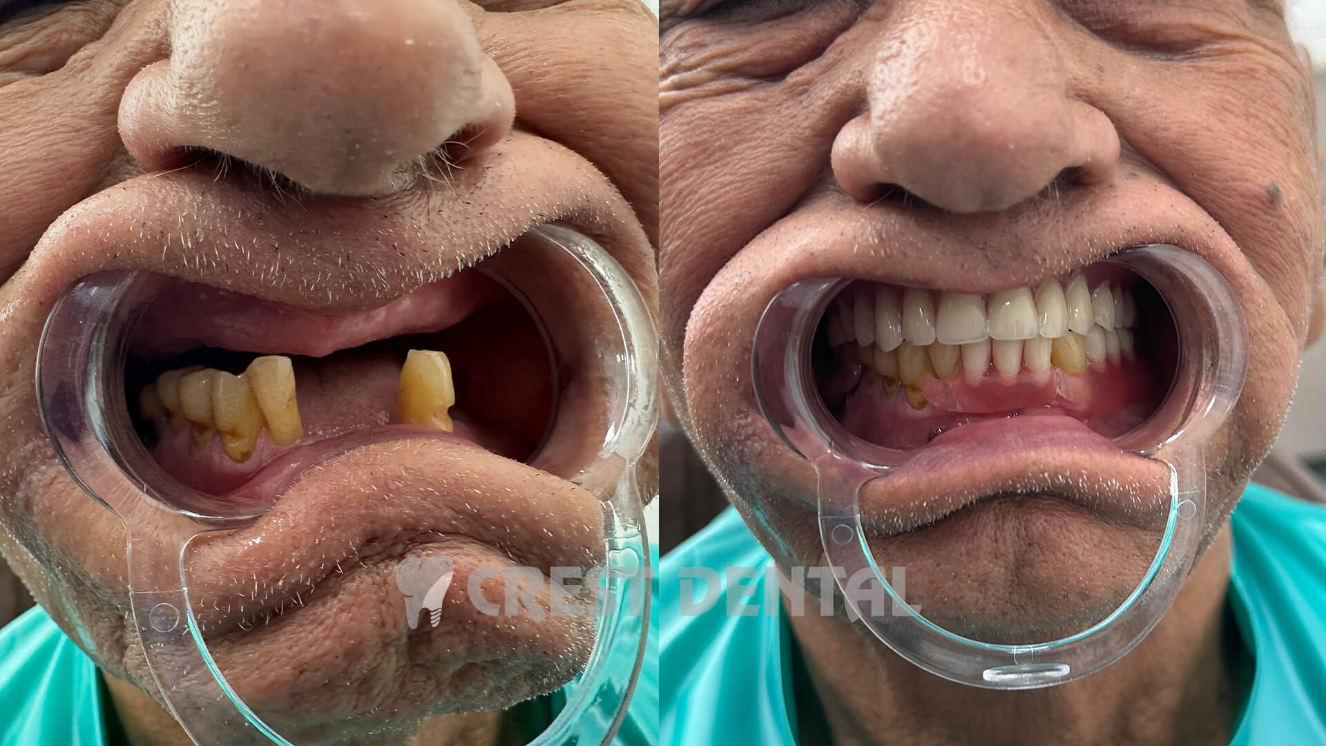 Complete and partial dentures at Crest Dental Sector 63 Gurgaon - tooth replacement solution