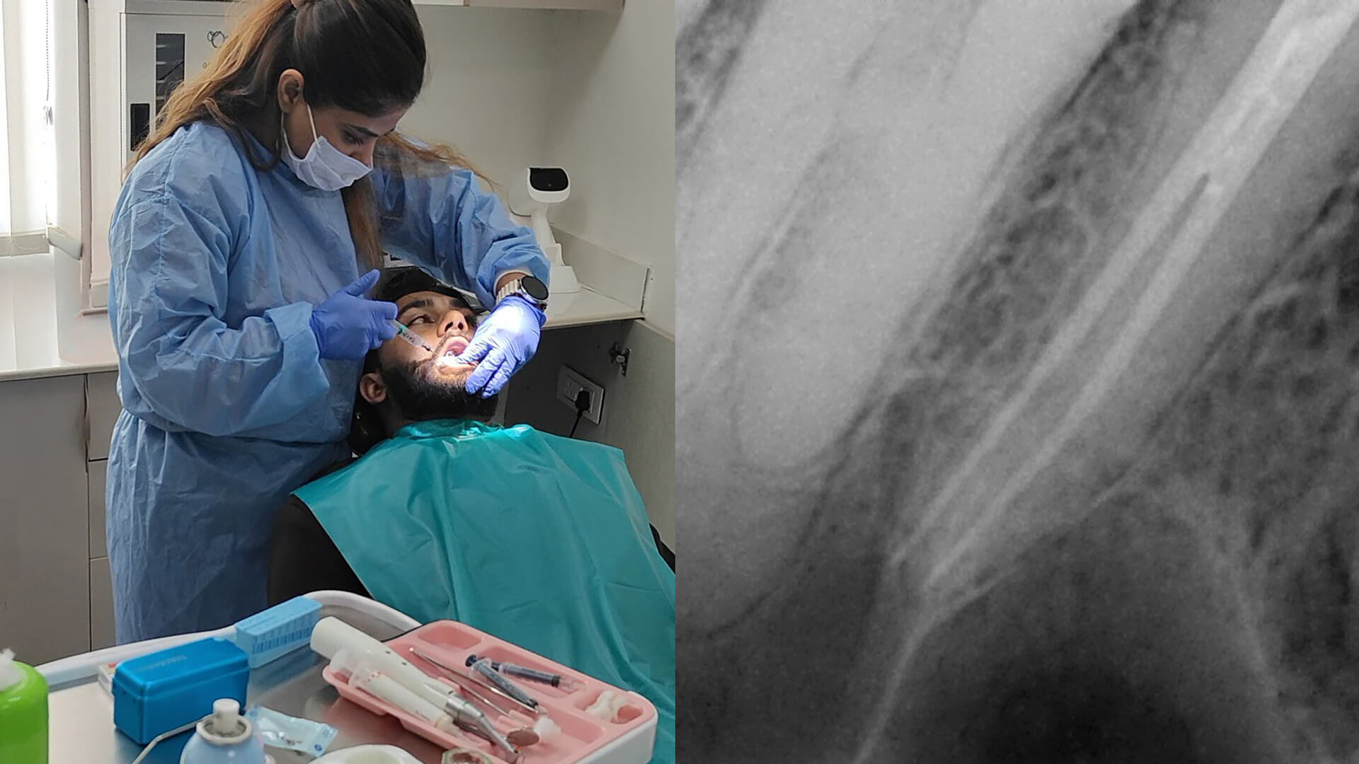 Root canal treatment procedure at Crest Dental Sector 63 Gurgaon - painless RCT by Dr. Tushita Kapoor
