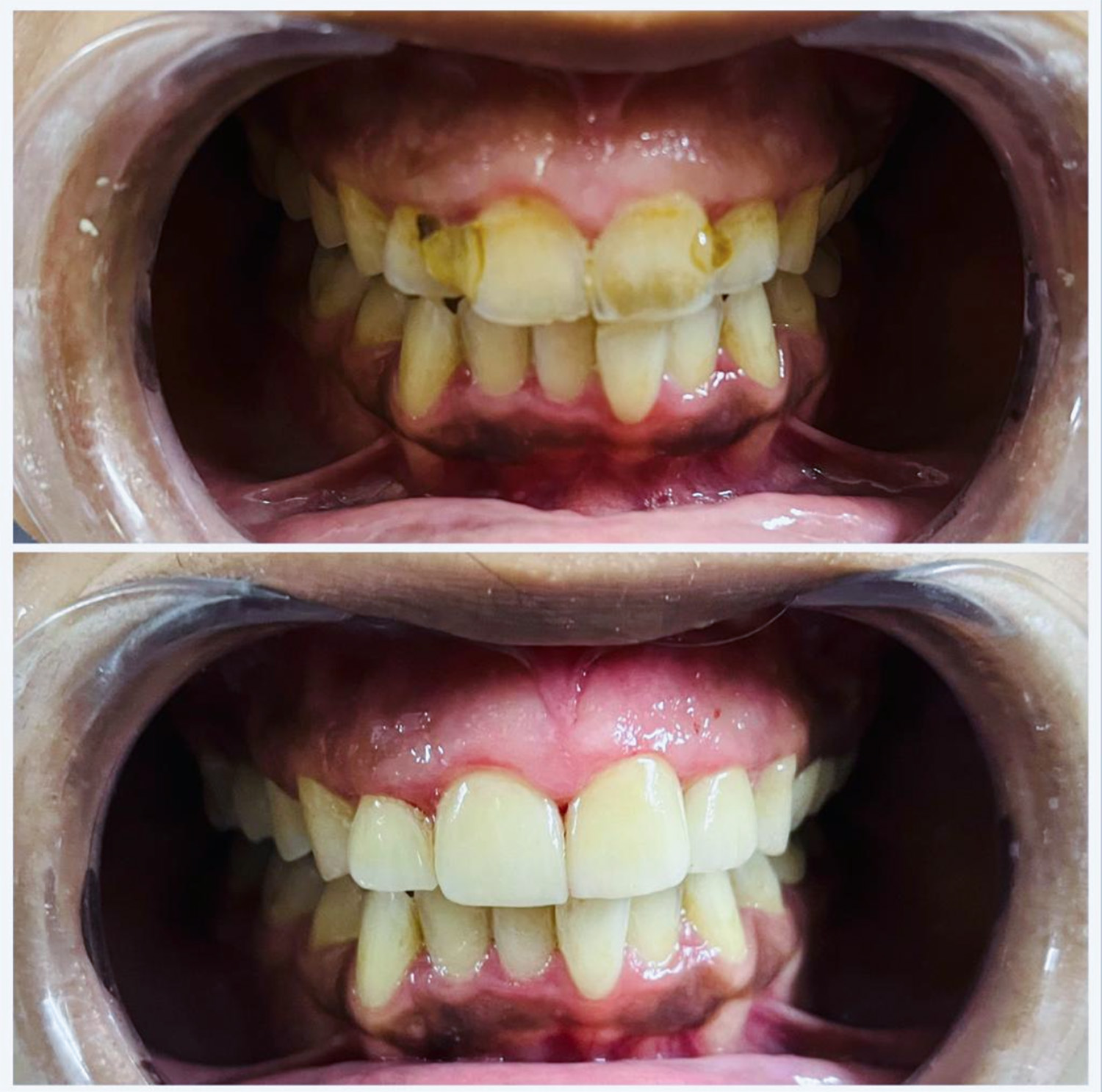 Dental veneers and laminates at Crest Dental Sector 63 Gurgaon - cosmetic smile makeover treatment
