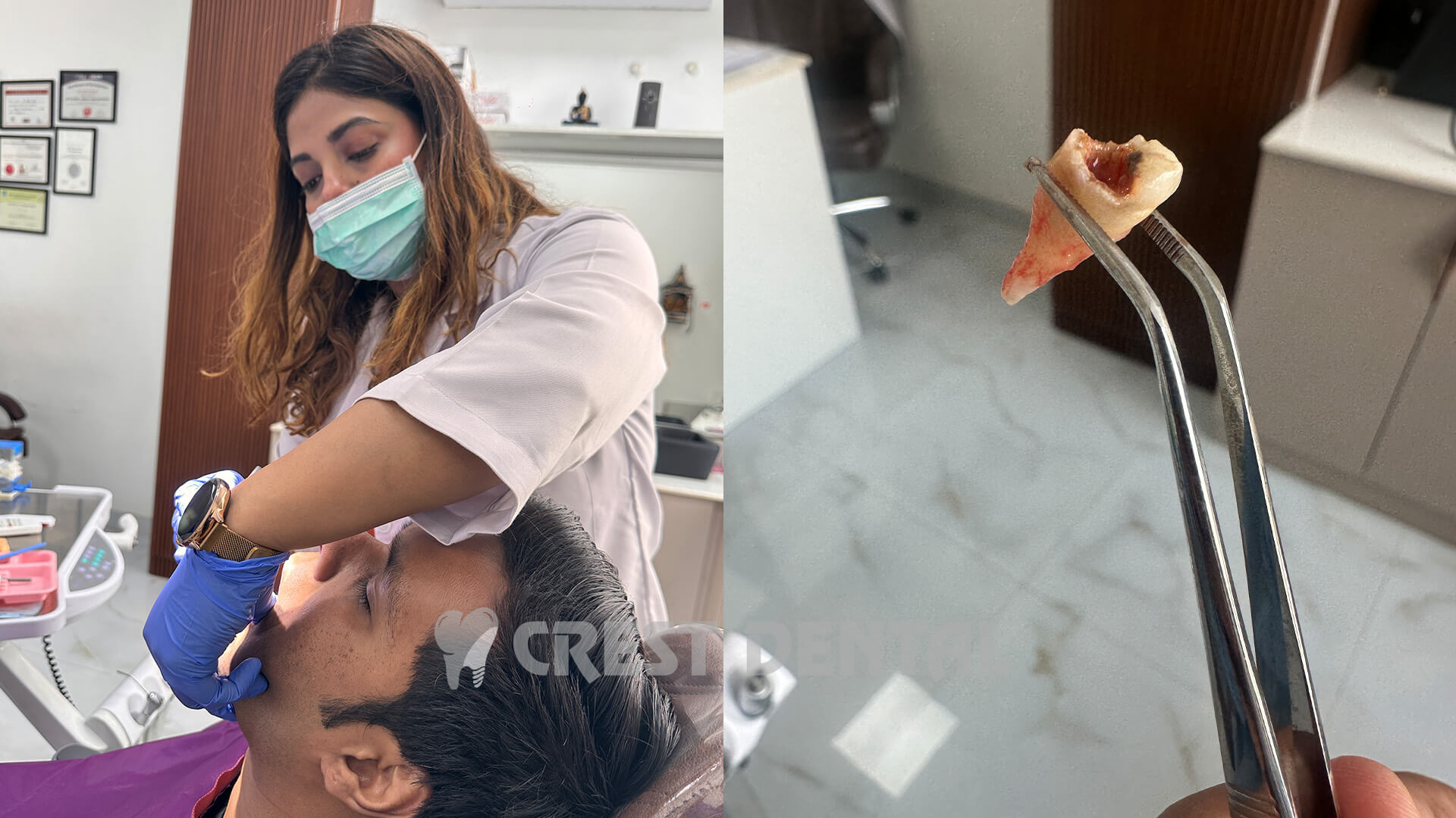 Tooth extraction and wisdom tooth removal at Crest Dental Sector 63 Gurgaon - painless dental surgery